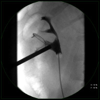 Abbildung Entfernung von großen Nierensteinen über die Haut (perkutane Nephrolithotomie