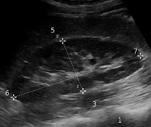 Abbildung Normale Ultraschalluntersuchung einer Niere